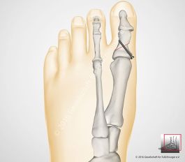 nach Entnahme eines Knochenkeils aus dem Großzehengrundglied