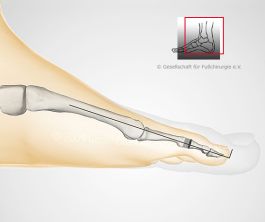 Hammerzeh-Op mit Köpfchenentfernung und Draht