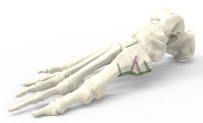 Plantare Lapidusplatte