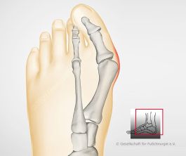 Hallux valgus: mittelschwere Form