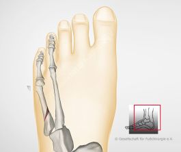 Kleinzehenballenkorrektur