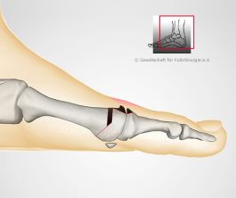 gelenkerhaltende Operation