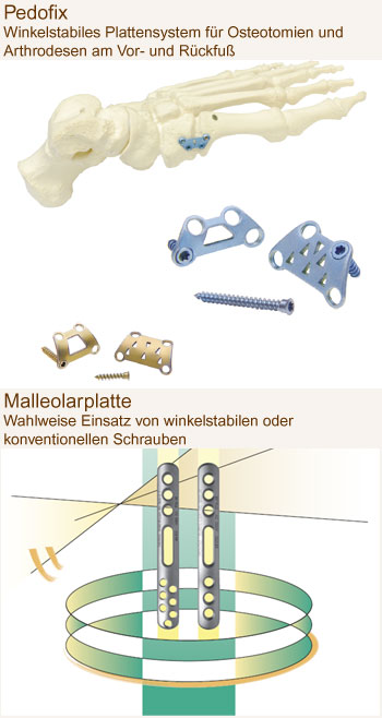 Pedofix und Maleolarplatte