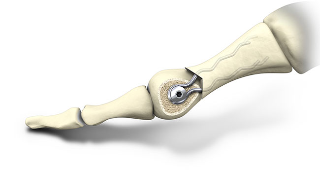 Implantat Knochen