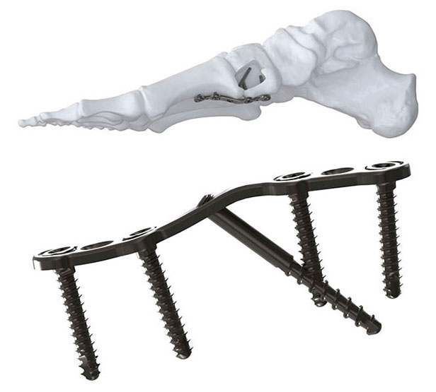 LAPIFIX Stufenplatten