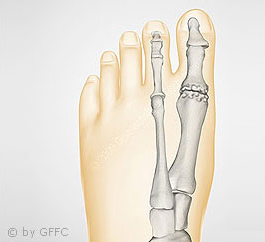 Hallux rigidus